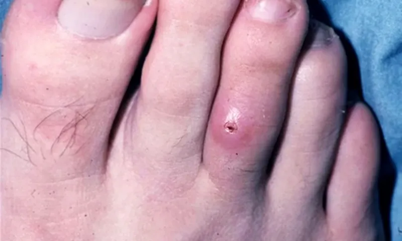 Phát hiện thêm ca mắc bệnh giòi ăn thịt người