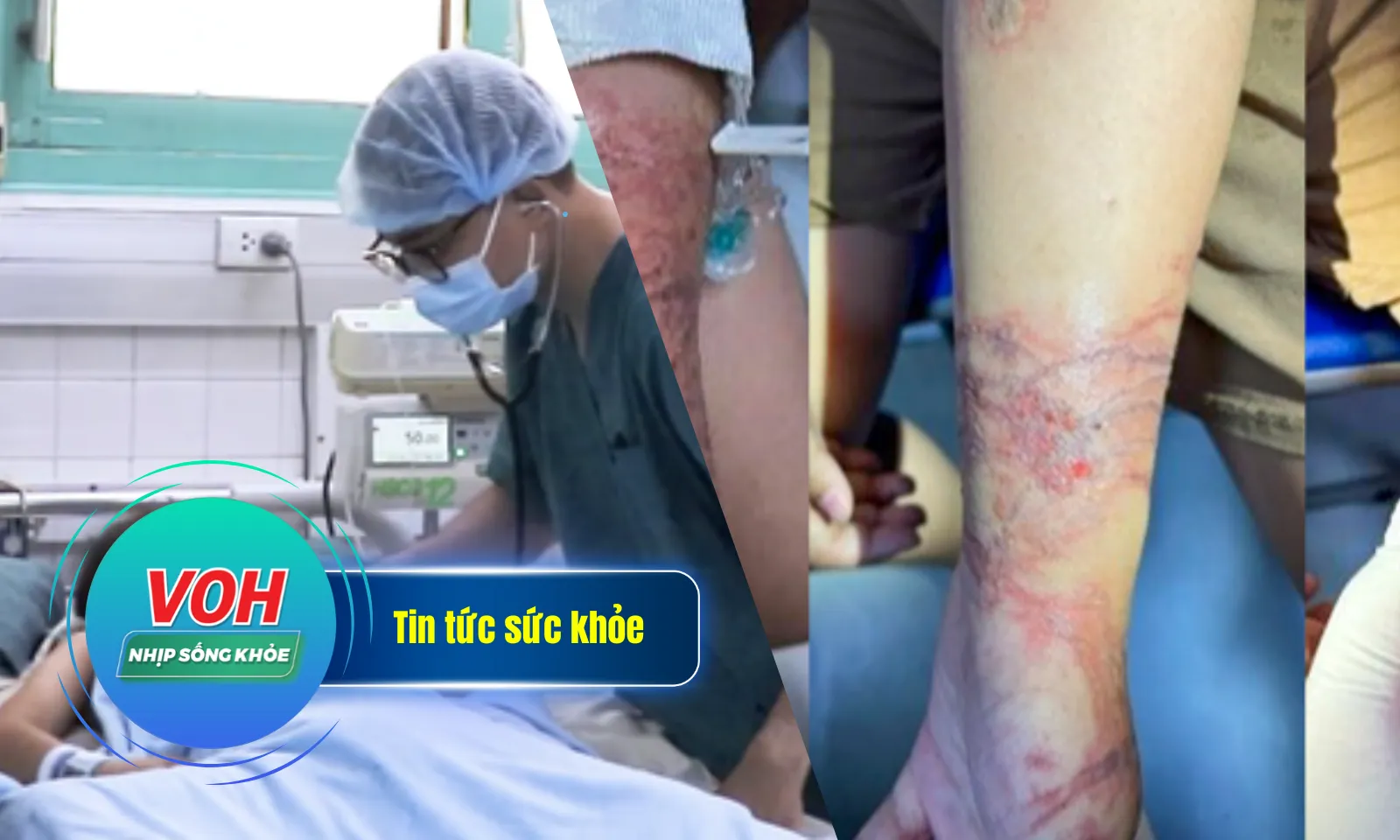 Nhịp sống khỏe 27/5: Ngưng tim sau 10 phút bị cuốn vào cửa| Viêm da nặng do tiếp xúc với sứa biển