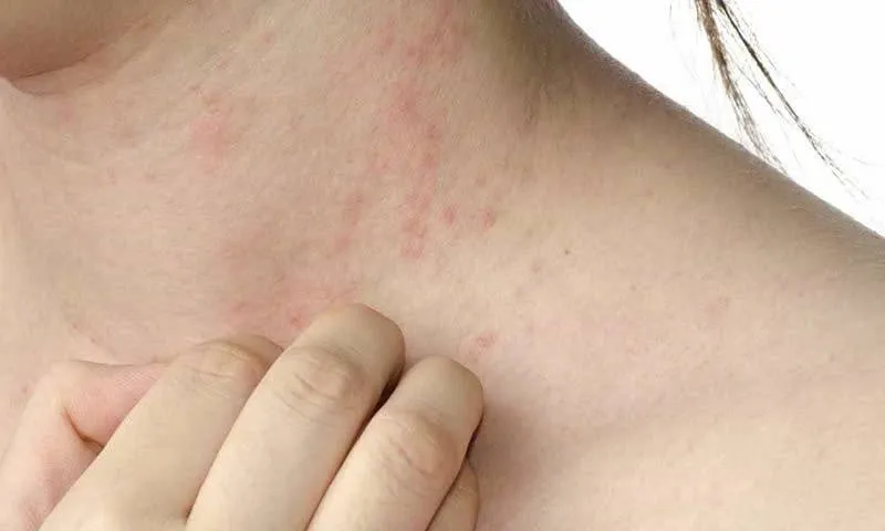 TPHCM cảnh báo nguy cơ dịch sởi: hơn 9.000 ca mắc, 7 người tử vong