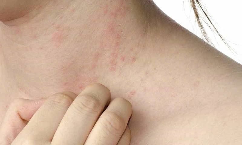 TPHCM cảnh báo nguy cơ dịch sởi: hơn 9.000 ca mắc, 7 người tử vong