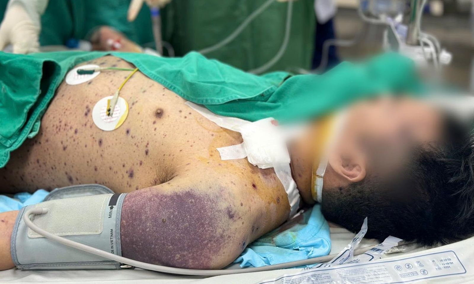 2 thanh niên khỏe mạnh mắc thủy đậu vẫn gặp biến chứng nguy kịch