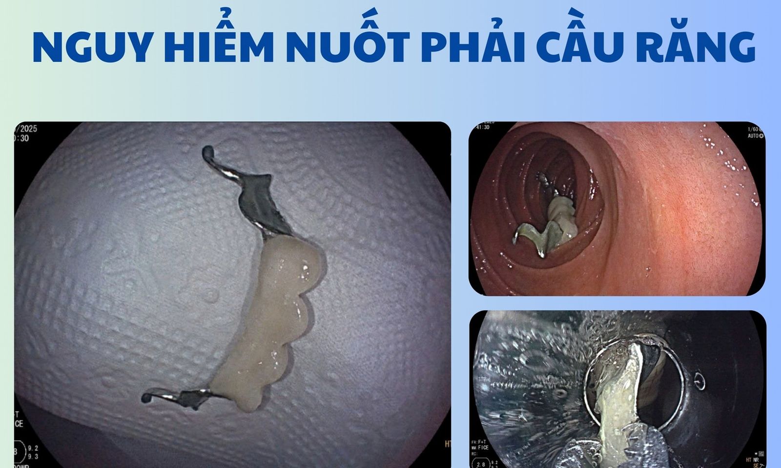 Nam thanh niên nuốt phải ‘cầu răng giả’ khi uống thuốc