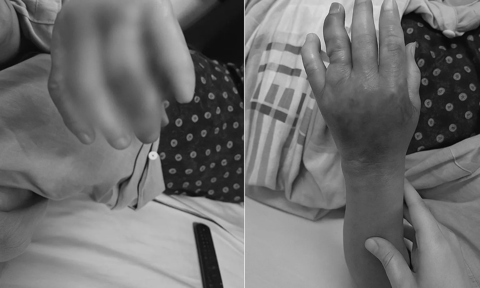 Nhiễm khuẩn huyết sau khi bị cá ba gai đâm