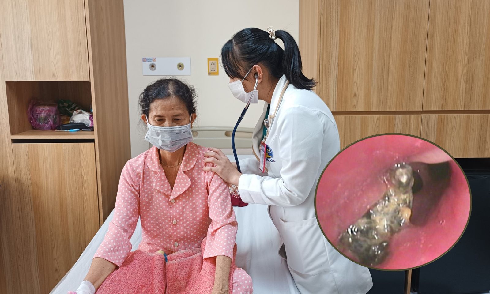 Viêm phổi tái đi tái lại suốt 1 năm vì dị vật lạ mắc ở phế quản