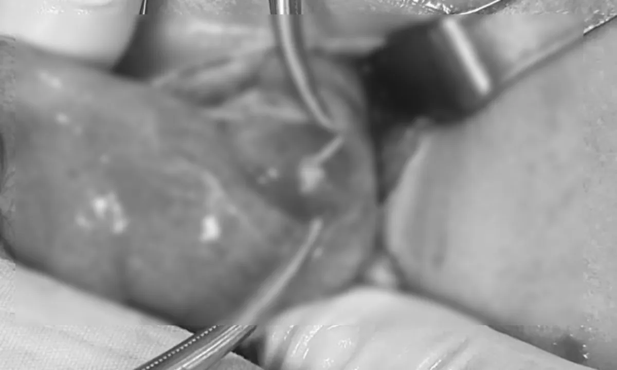 Bé trai 2 tuổi bị thủng ruột vì xương cá điêu hồng