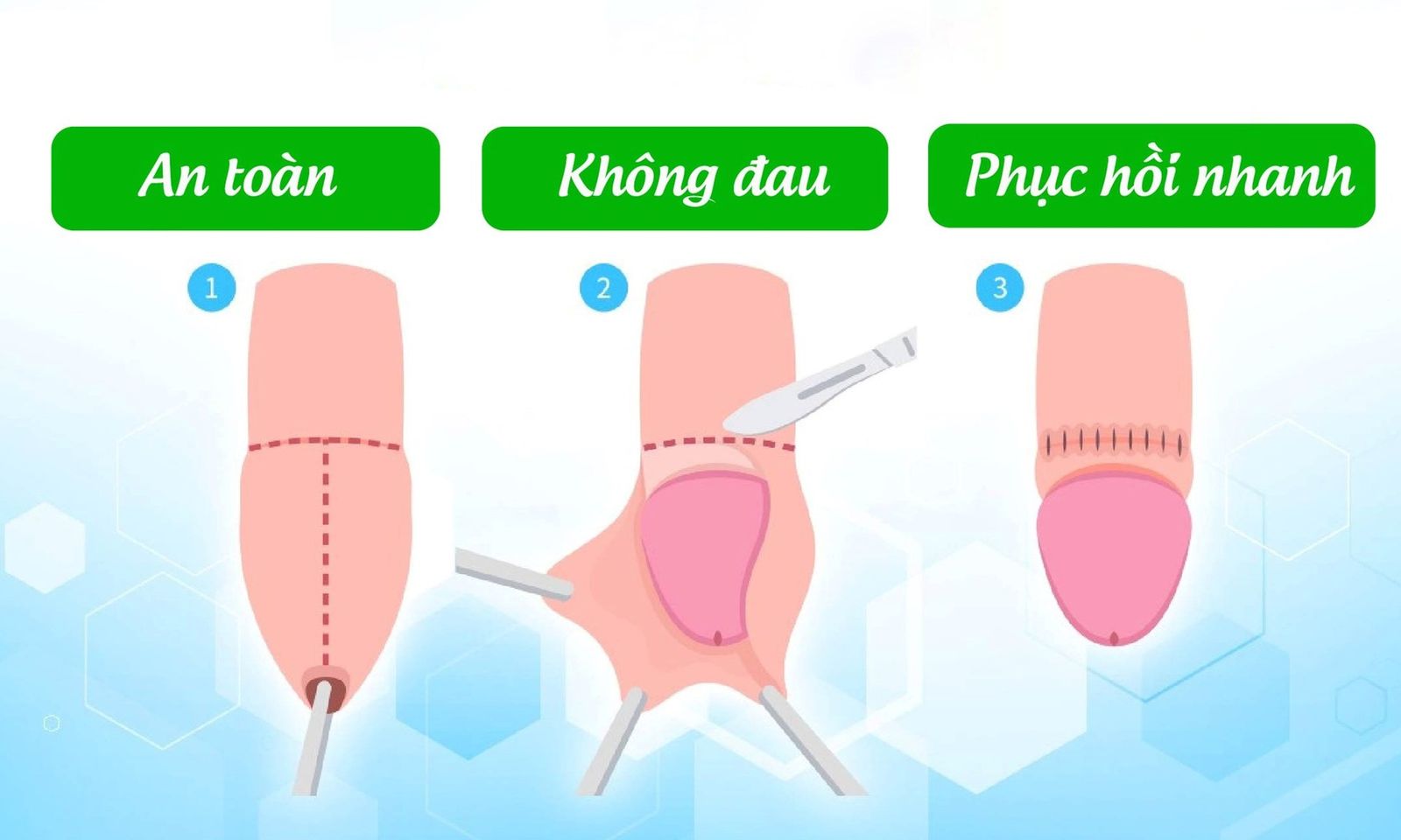 Thiếu niên 16 tuổi phải nhập viện do tự lộn bao quy đầu