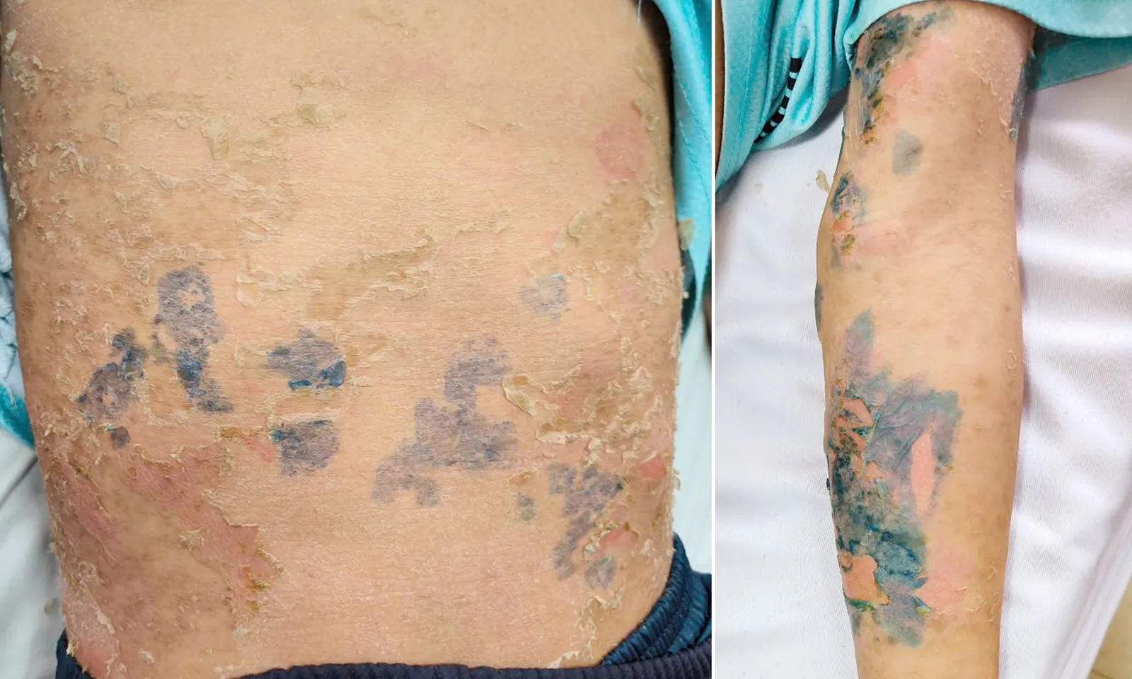 Lột da toàn thân vì uống thuốc nam, tắm nước lá chữa bệnh sởi