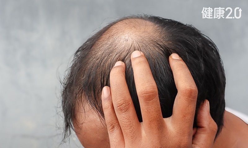 Uống nhiều đồ uống có đường làm tăng nguy cơ hói đầu lên gấp 3 lần!