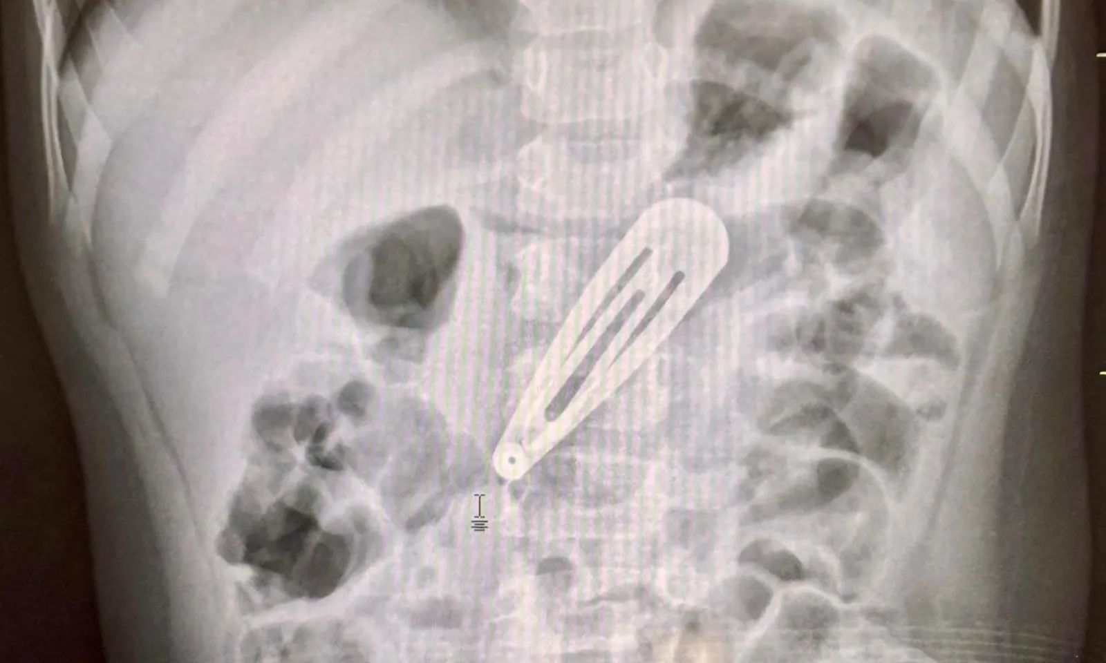 Kẹp tóc dài 5cm trong dạ dày bé gái 2 tuổi