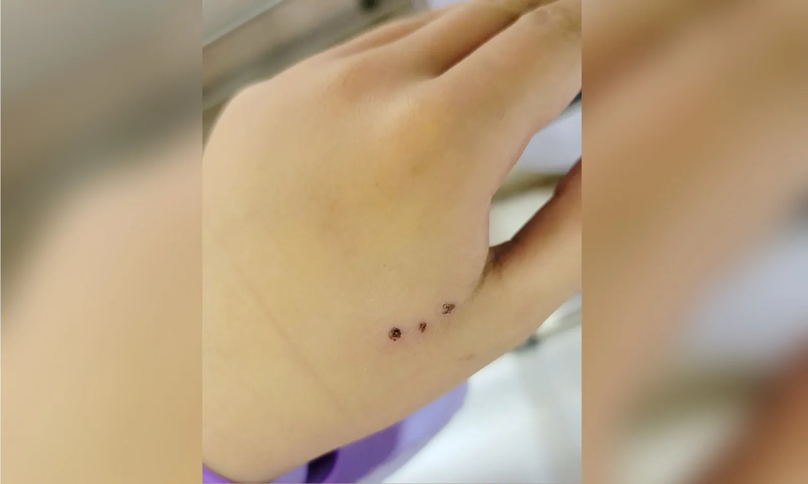 Bị chuột cắn cũng cần tiêm vaccine phòng dại