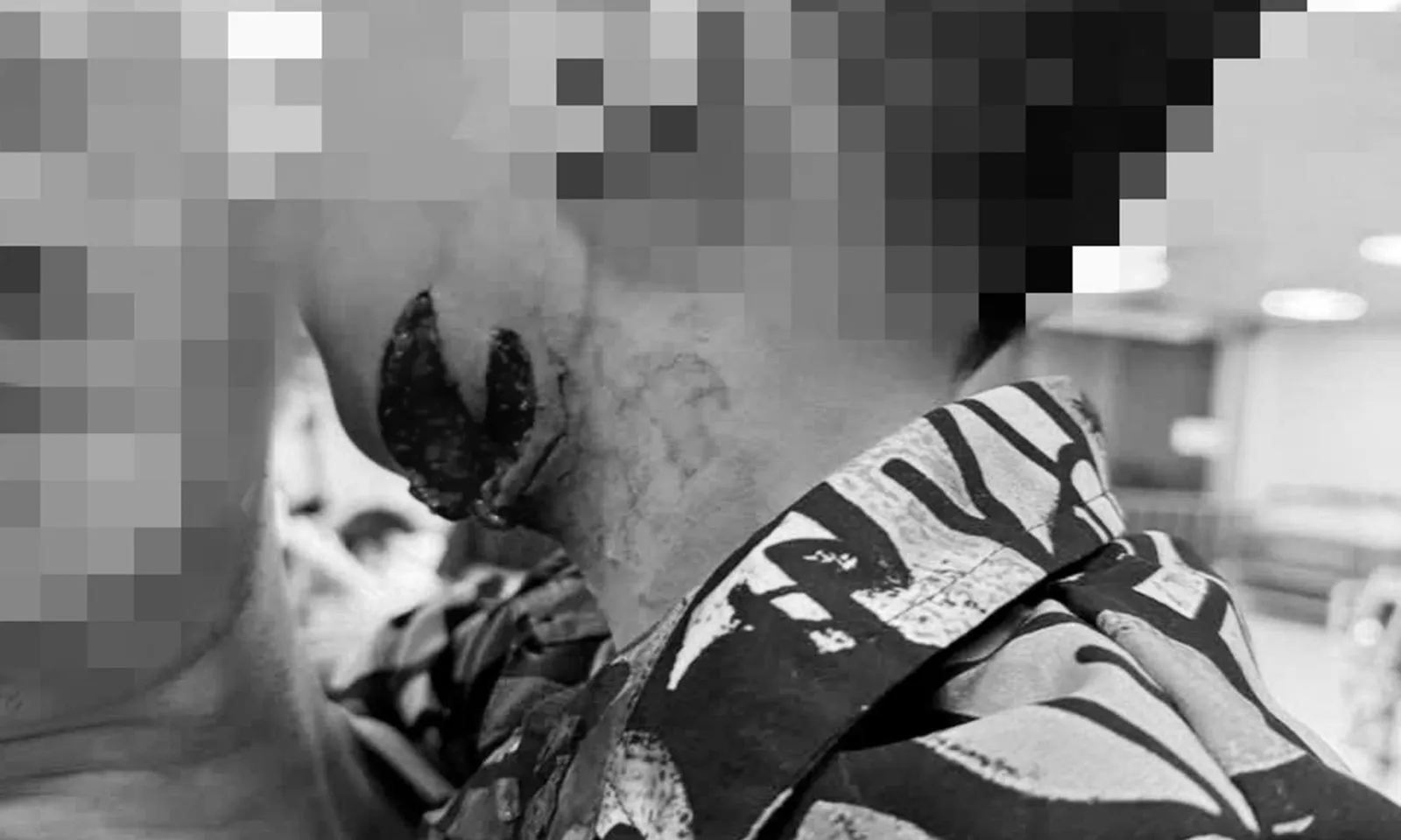 Mới đầu mùa hè, nhiều trẻ bị chó cắn phải nhập viện