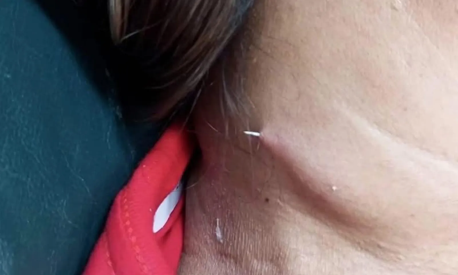 Hy hữu: Xương cá kẹt trong cổ họng rồi đâm xuyên qua da người phụ nữ