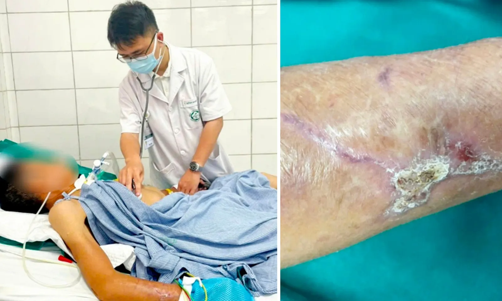 Không tiêm phòng khi bị cây gỗ đâm rách tay, hai bệnh nhân bị uốn ván nặng