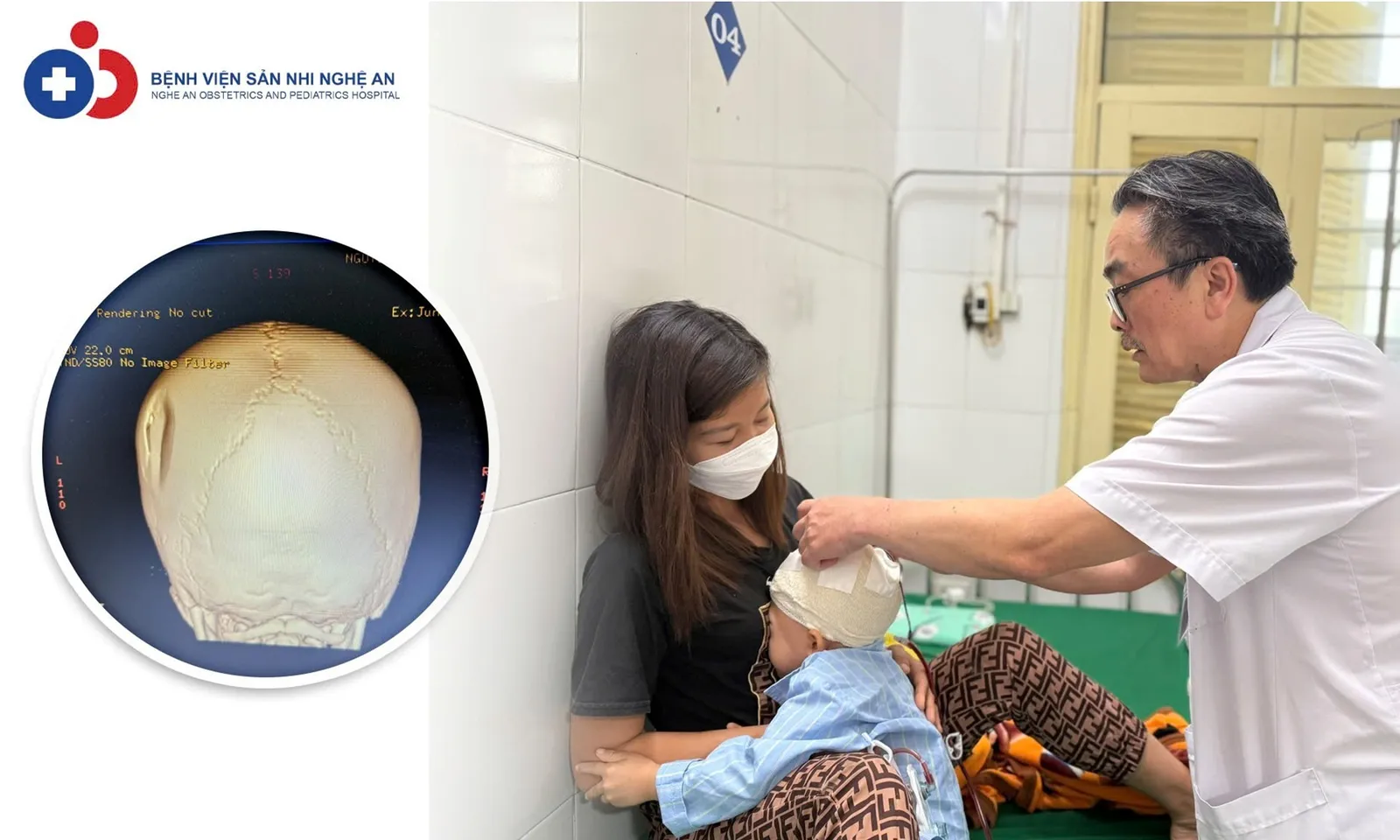 Cứu sống bé trai chấn thương sọ não do bị xe đạp điện tông