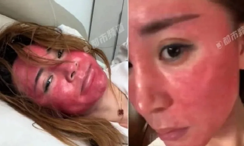 Viêm da cấp tính vì 22 năm không tẩy trang