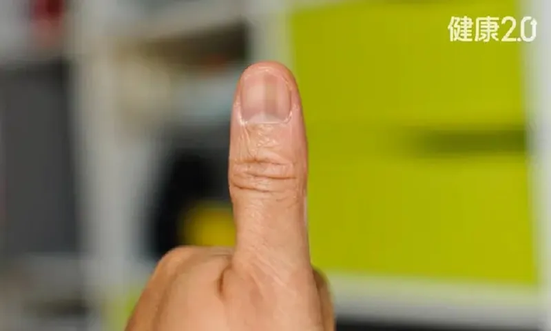 Đường sọc đen trên móng tay có phải là ung thư? 