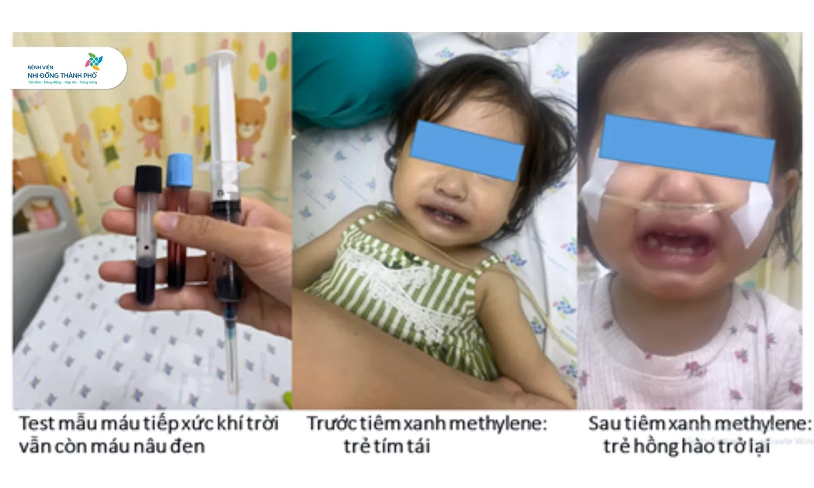 Bé gái 16 tháng tuổi tím tái, nguy kịch sau khi ăn ghẹ và canh cải bó xôi nấu với nước giếng