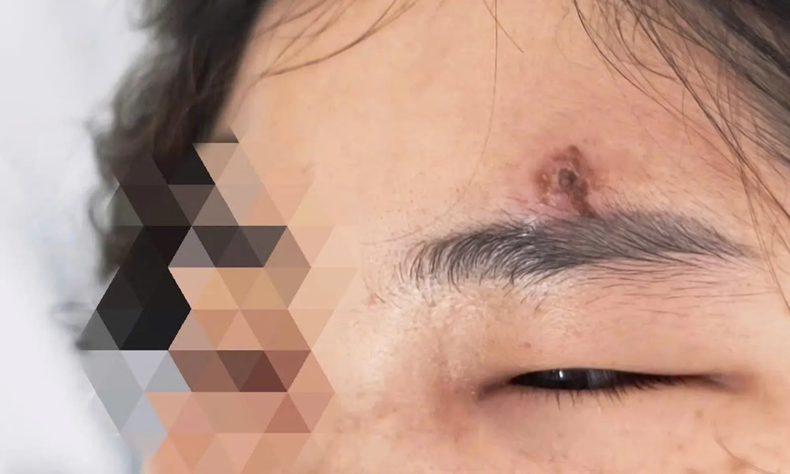 Nặn mụn bọc trên trán, người phụ nữ phải nhập viện điều trị vì viêm mô bào