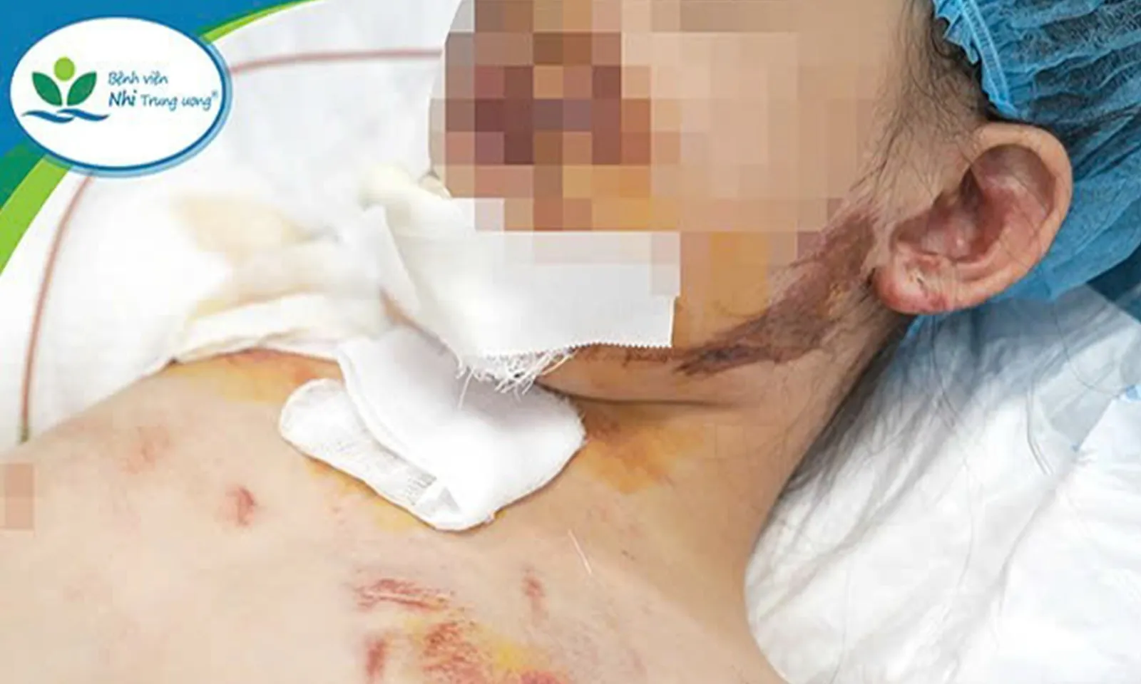 Bé trai hôn mê sâu vì bị cổng sắt đổ vào người