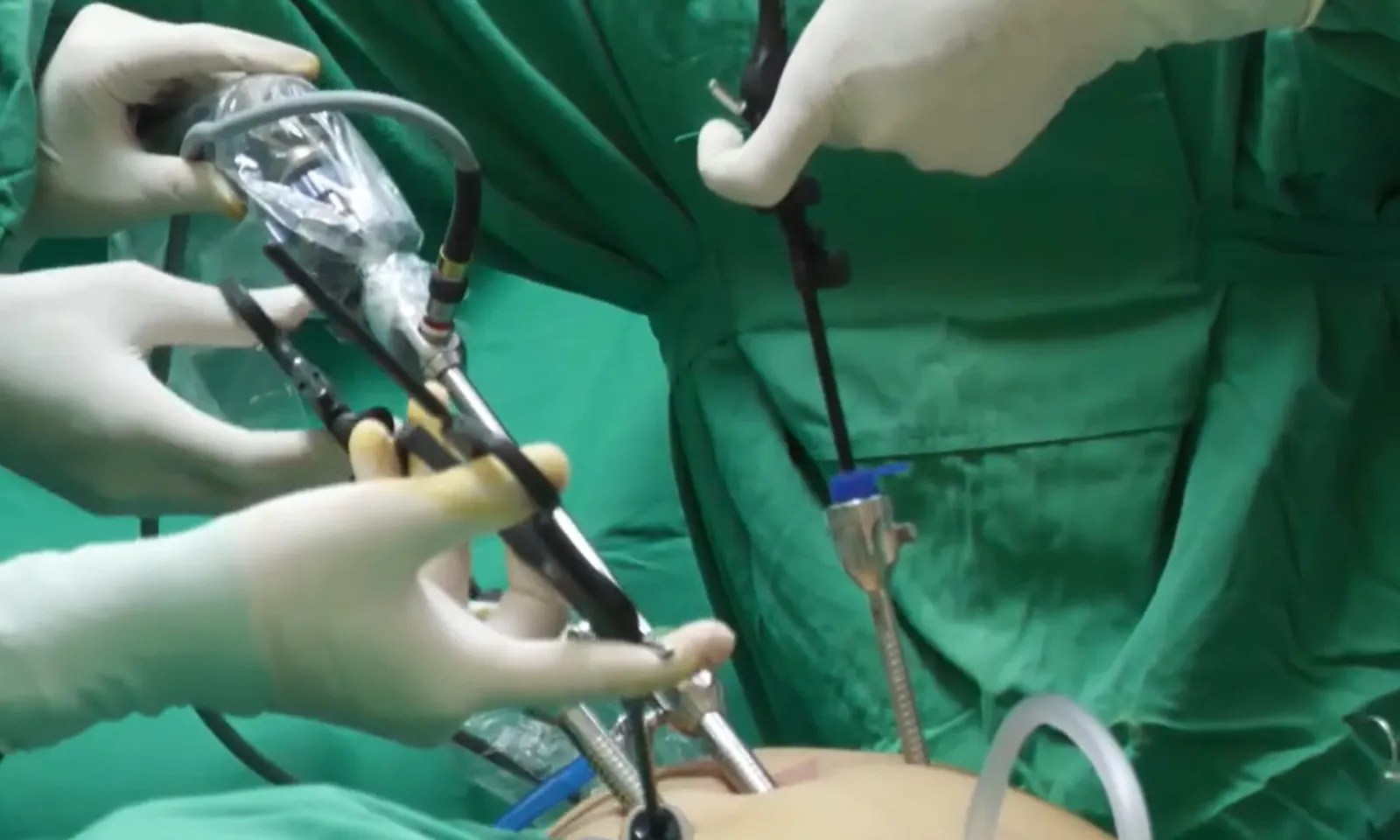 Cụ bà bị vỡ bàng quang nhiều ngày mà không hay biết