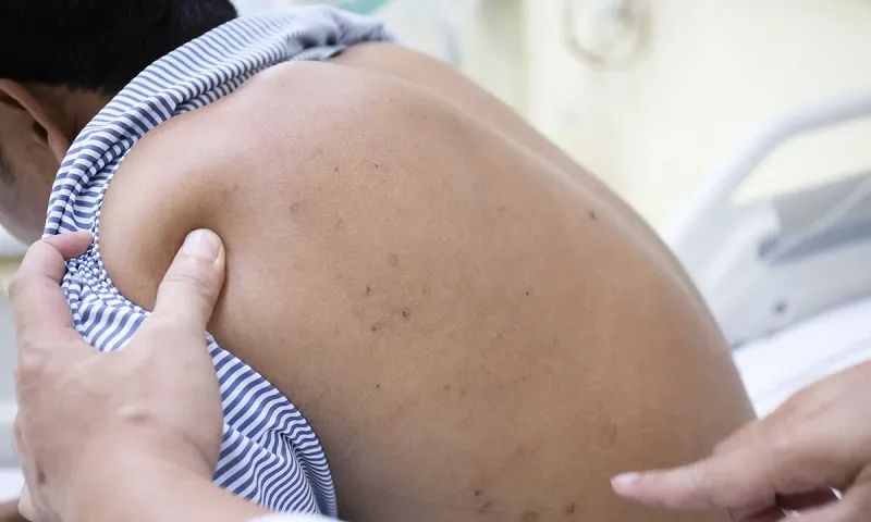 Cứu sống kịp thời bệnh nhân bị ong vò vẽ đốt nguy kịch