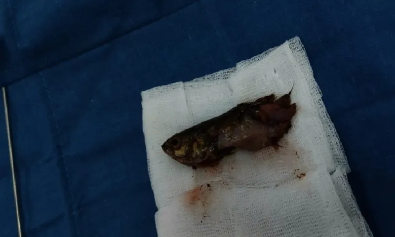 Bé trai 4 tuổi suýt nguy kịch vì nuốt cá rô sống