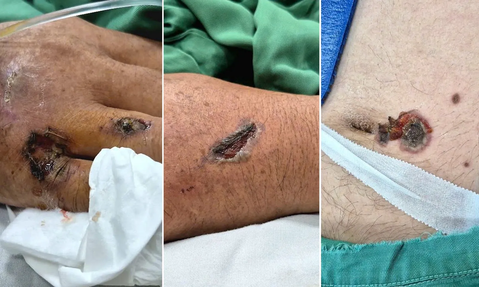 Cứu người đàn ông ngừng tuần hoàn nghi do điện giật khi sửa bồn nước