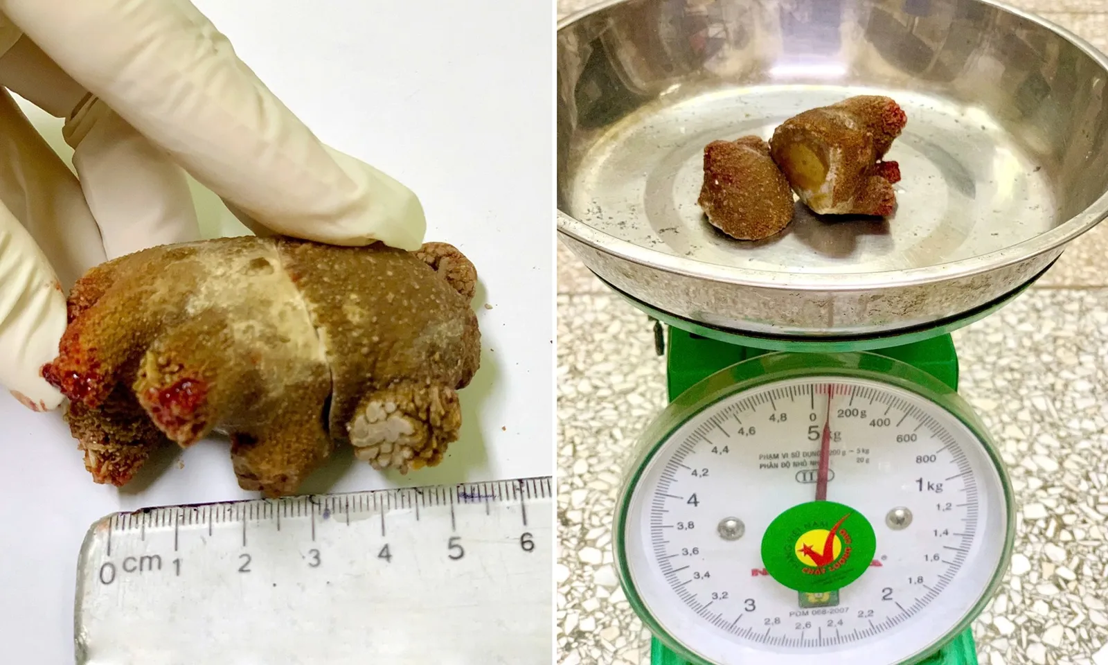 Sỏi thận “khổng lồ” như san hô âm thầm phát triển trong gần 20 năm