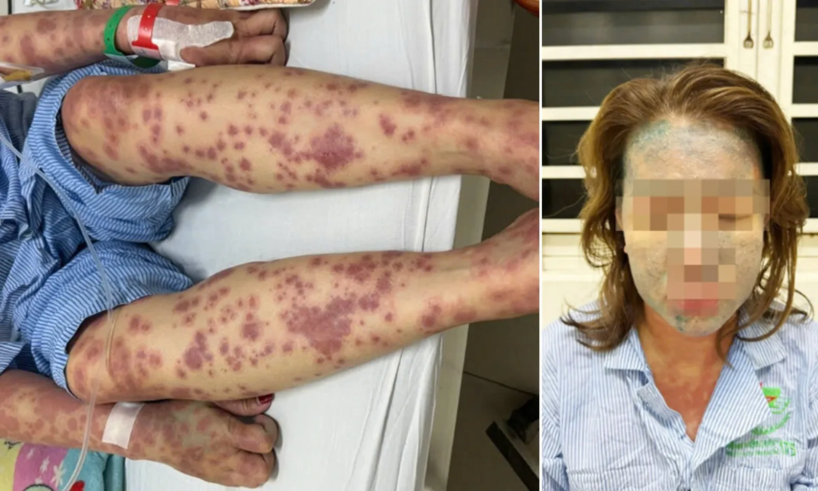 Nguy kịch sau khi dùng thuốc ‘giảm cân thải độc, collagen’ không rõ nguồn gốc