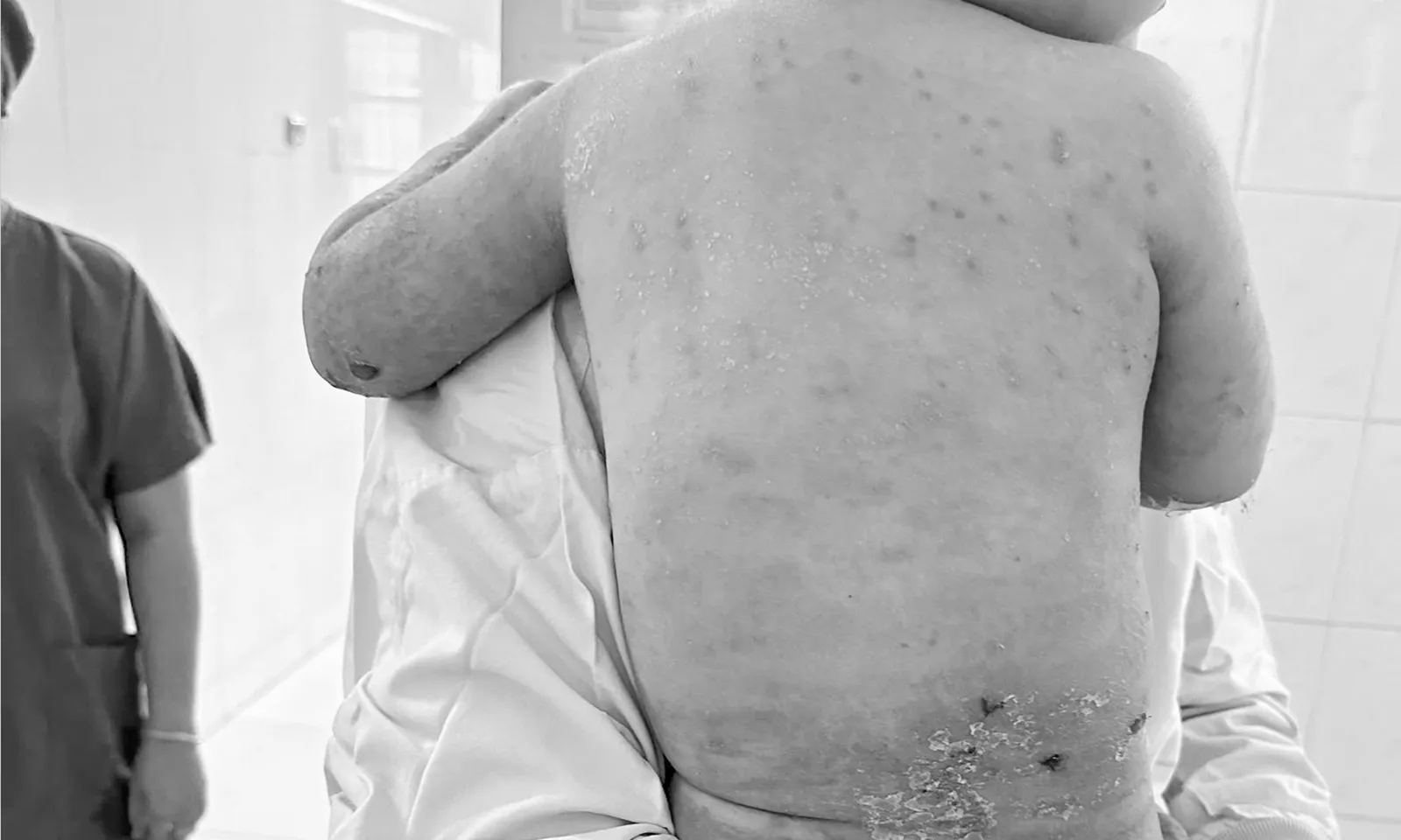 Mẹ hiến da cứu con 2 tuổi bị phỏng 60%