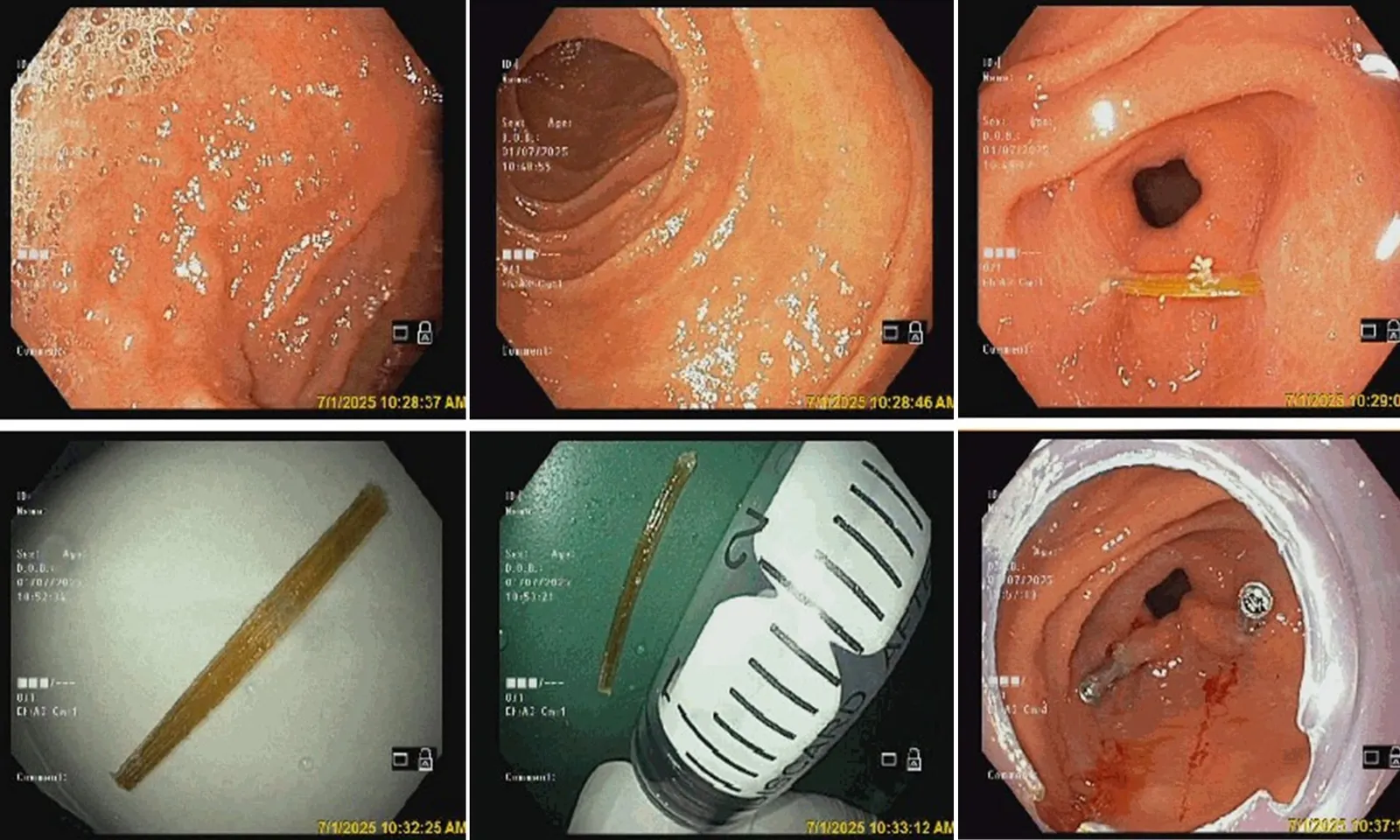 Em bé 8 tuổi bị tăm tre đâm thủng dạ dày
