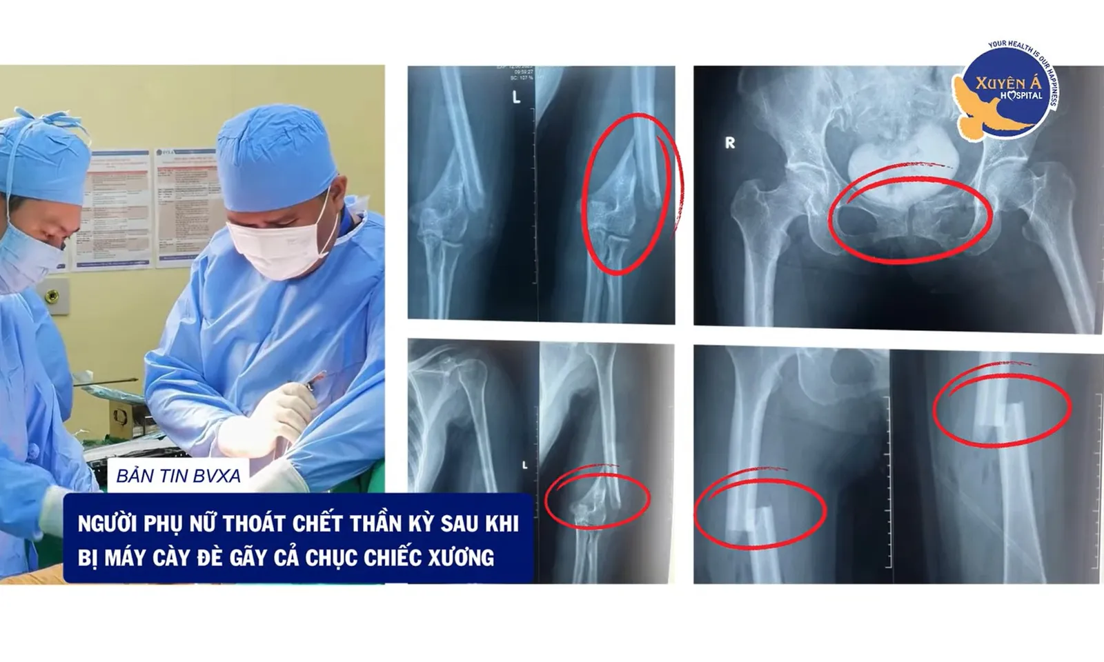 Hy hữu: Người phụ nữ thoát chết sau khi bị máy cày đè gãy cả chục chiếc xương