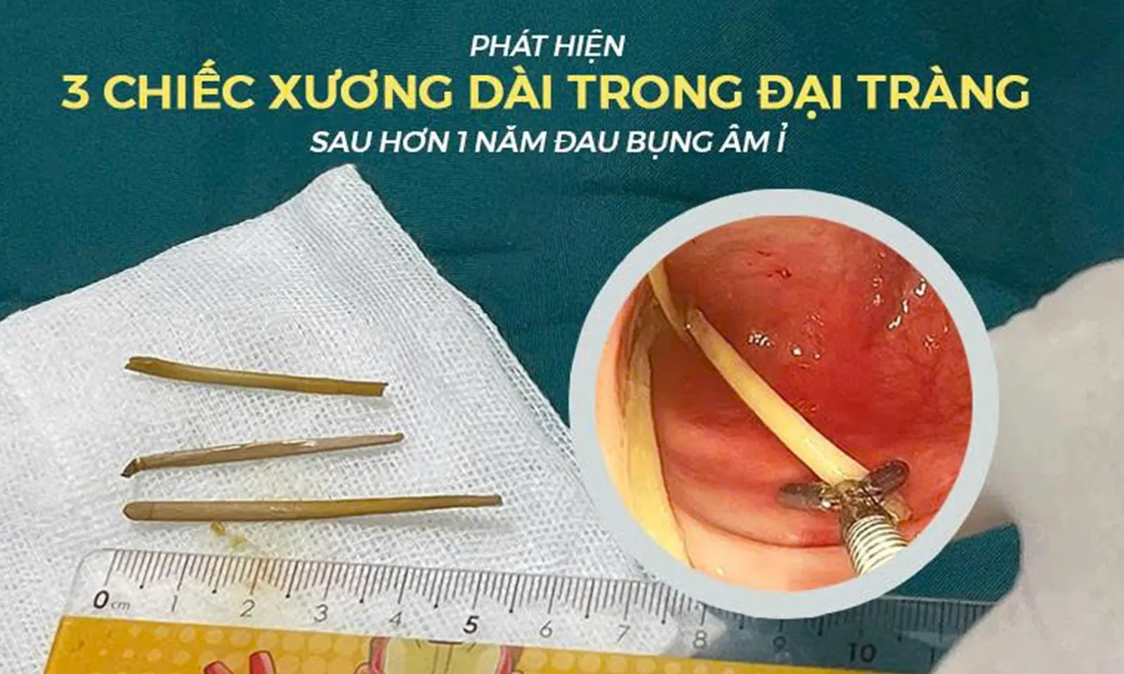 Phát hiện 3 chiếc xương dài cắm sâu vào đại tràng cụ ông sau hơn 1 năm đau bụng âm ỉ