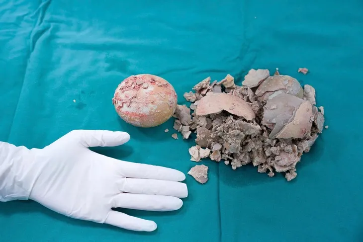 16-7-soi-bang-quang-3-175266243886181998657