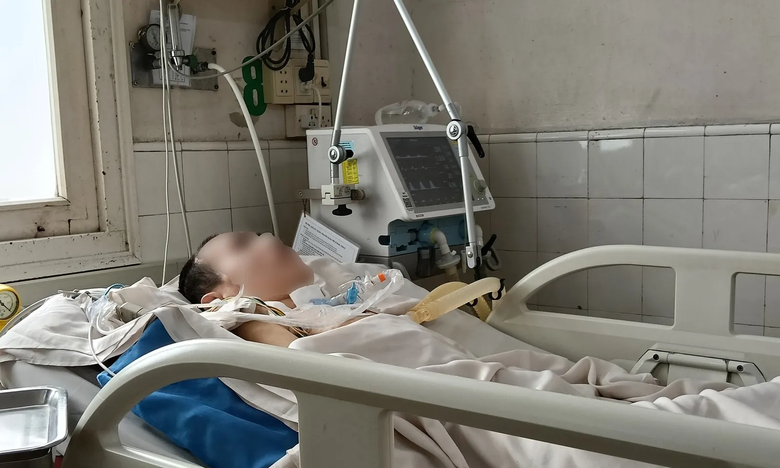 Thanh niên 26 tuổi thở máy gần 2 năm do di chứng viêm não Nhật Bản