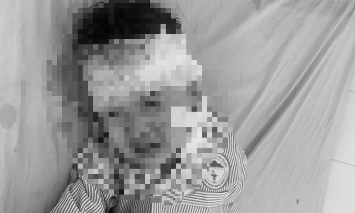 Bé trai 3 tuổi bị chó cắn lộ xương sọ