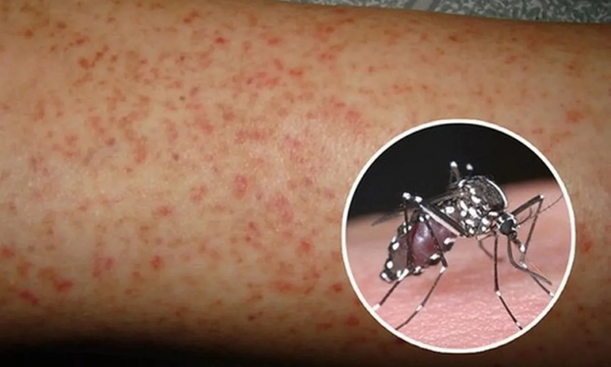 Đắk Lắk ghi nhận ca tử vong đầu tiên vì sốt xuất huyết năm 2025