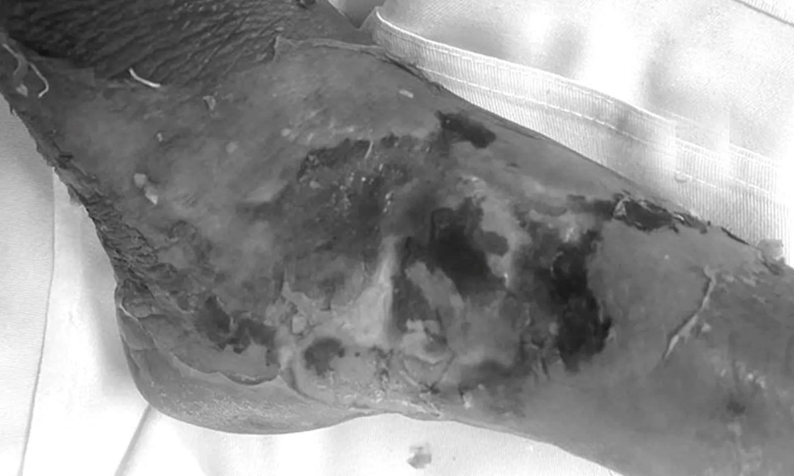 Nhiễm trùng nặng vì đắp lá trị rắn cắn