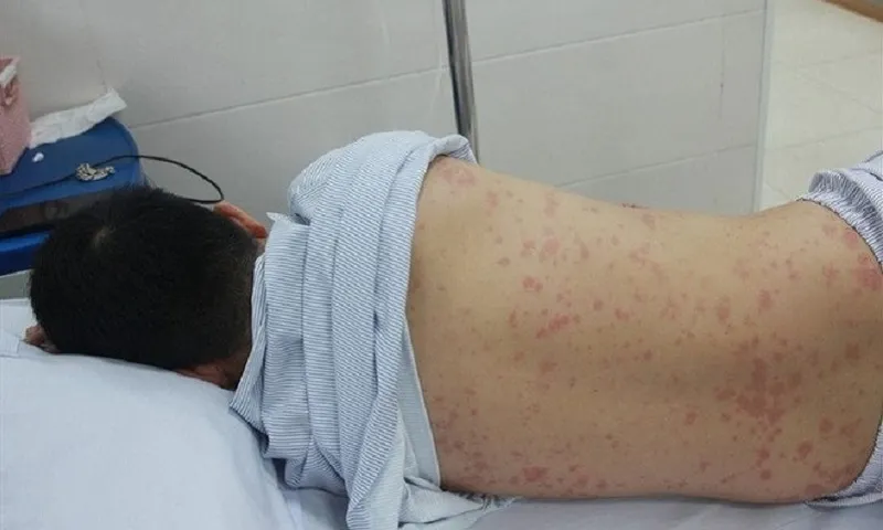 Hà Nội ghi nhận trường hợp thứ 6 mắc bệnh liên cầu lợn