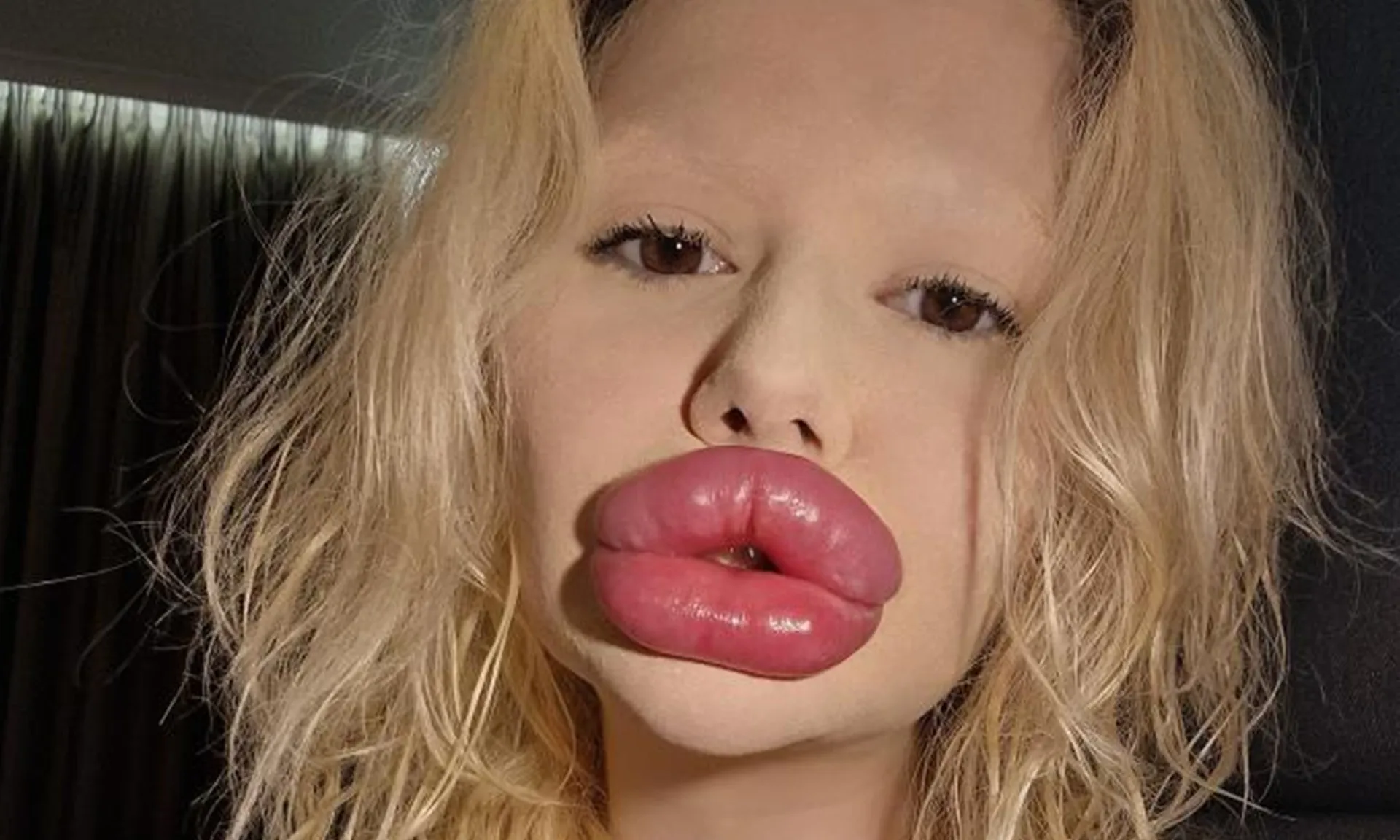 Người phụ nữ chi hơn 26.000 đô la để có 'đôi môi lớn nhất thế giới'