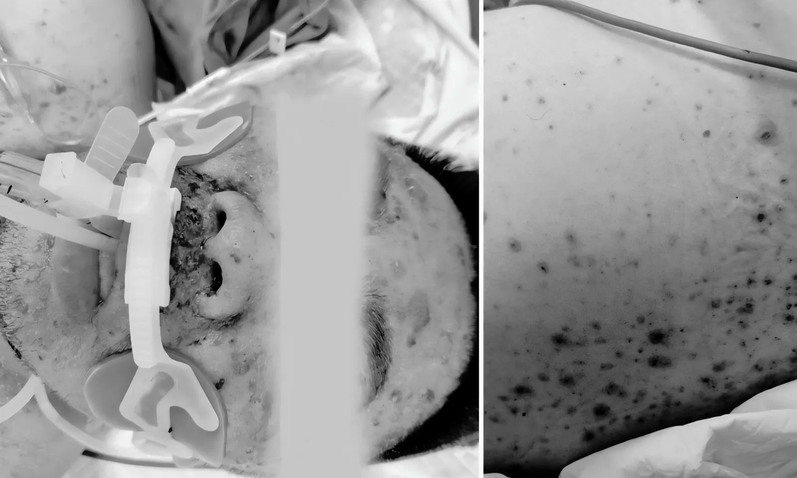 Chàng trai 30 tuổi suy đa tạng nguy kịch do biến chứng thủy đậu