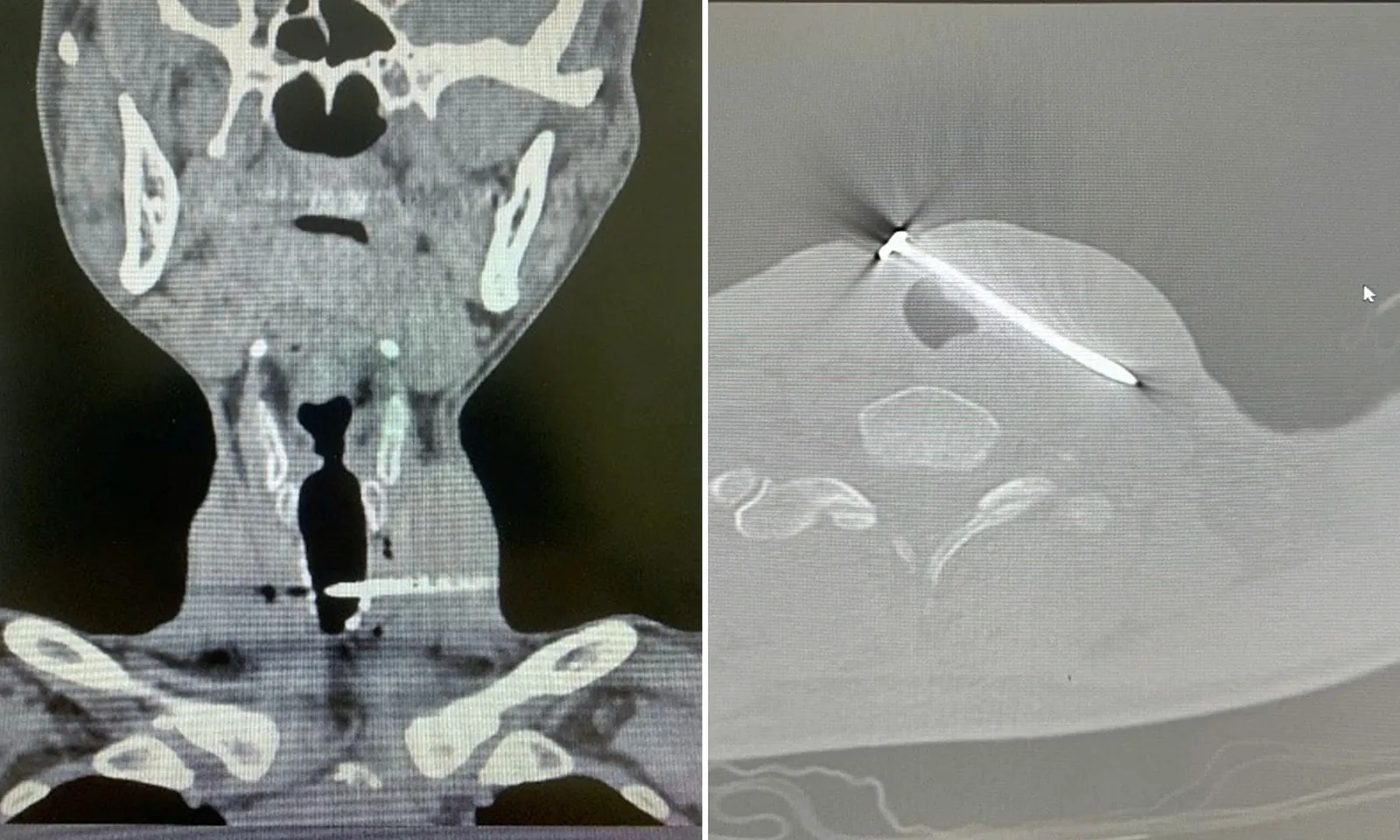 Người đàn ông bị đinh sắt cắm sâu vào giữa cổ