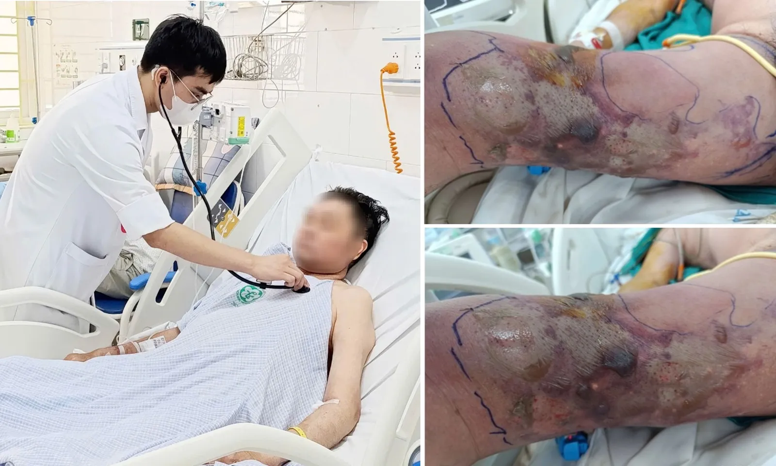 Bị sinh vật lạ đốt khi tắm biển, người đàn ông nhiễm trùng hoại tử nguy kịch