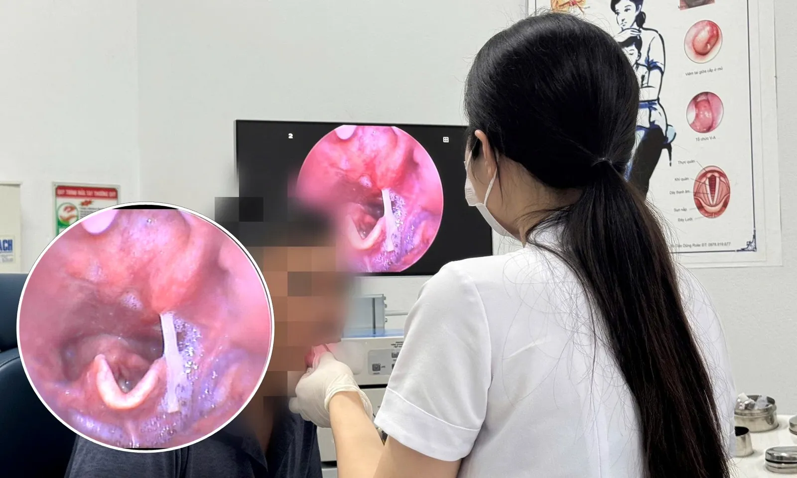 Người đàn ông bị xương cá dài 4,5 cm cắm vào hạ họng 