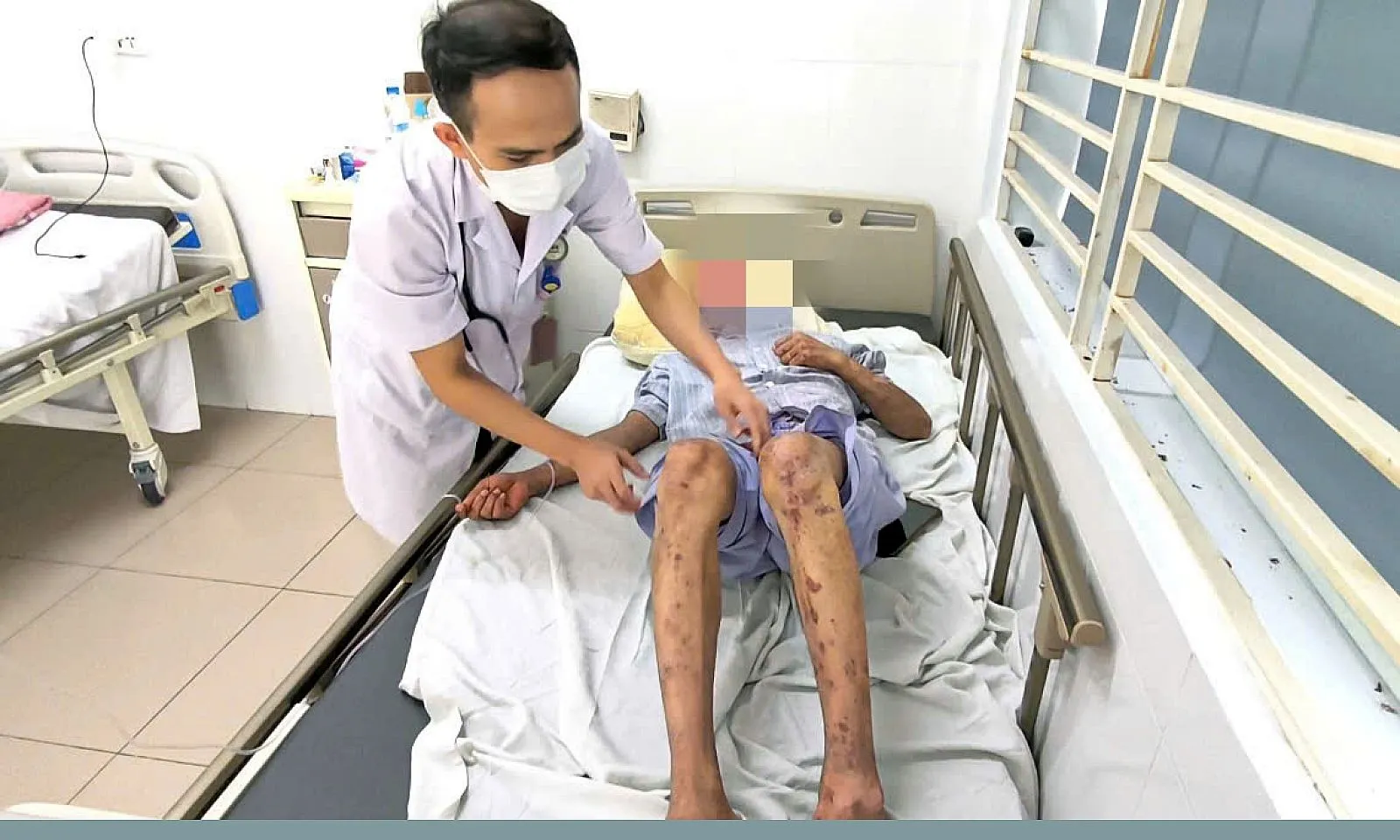 Bỏng toàn thân, mù tạm thời vì dị ứng silicon chống dột 