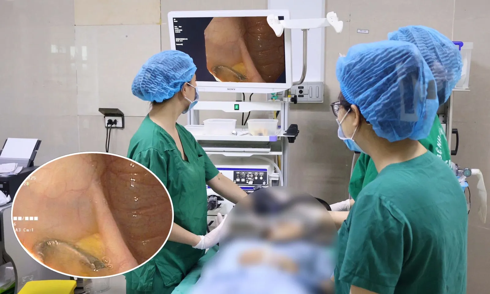 Em bé 5 tuổi nhập viện vì nuốt móc vòng bạc đeo tay