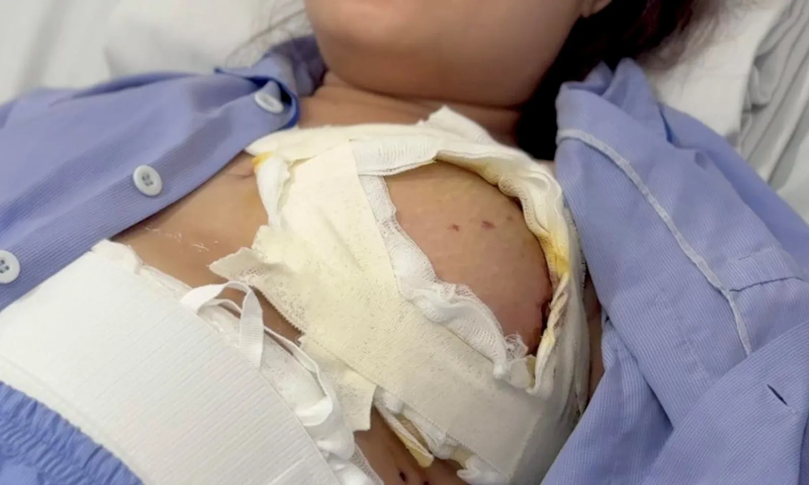 Dùng da và mỡ bụng để tái tạo ngực cho bệnh nhân ung thư vú