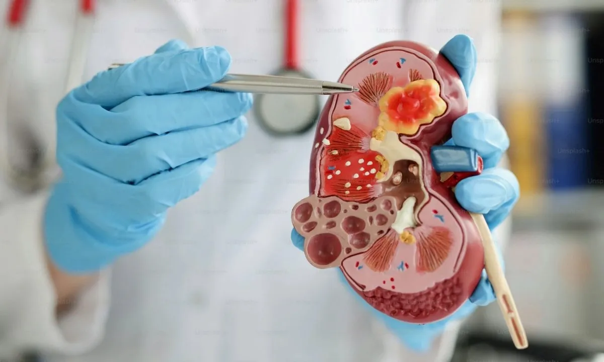 8 - 10 triệu người Việt mắc bệnh thận: WHO kêu gọi hành động sớm