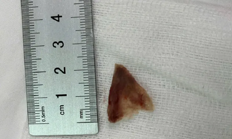 Bệnh nhân nhiễm trùng vì bị hóc xương, dùng mẹo dân gian vuốt ngược 