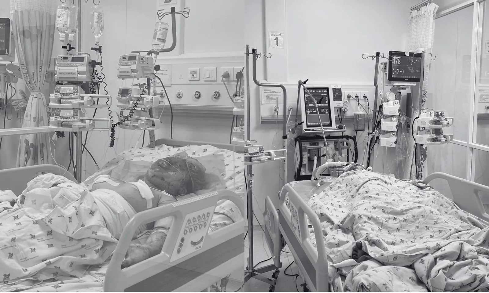 Thương tâm hai chị em bỏng thập tử nhất sinh do cha ruột phóng hỏa